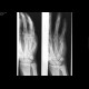Subcapital fracture of the fifth metacarpal, Boxer's fracture: X-ray - Plain radiograph